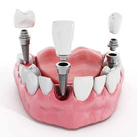 Image of Dental Implant Presentation of 1 Front Implant and 2 Back Implants