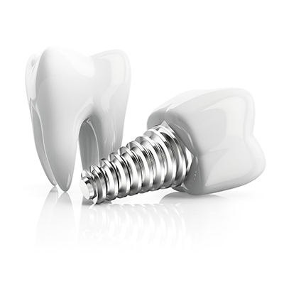 A Dental Implant and a Tooth