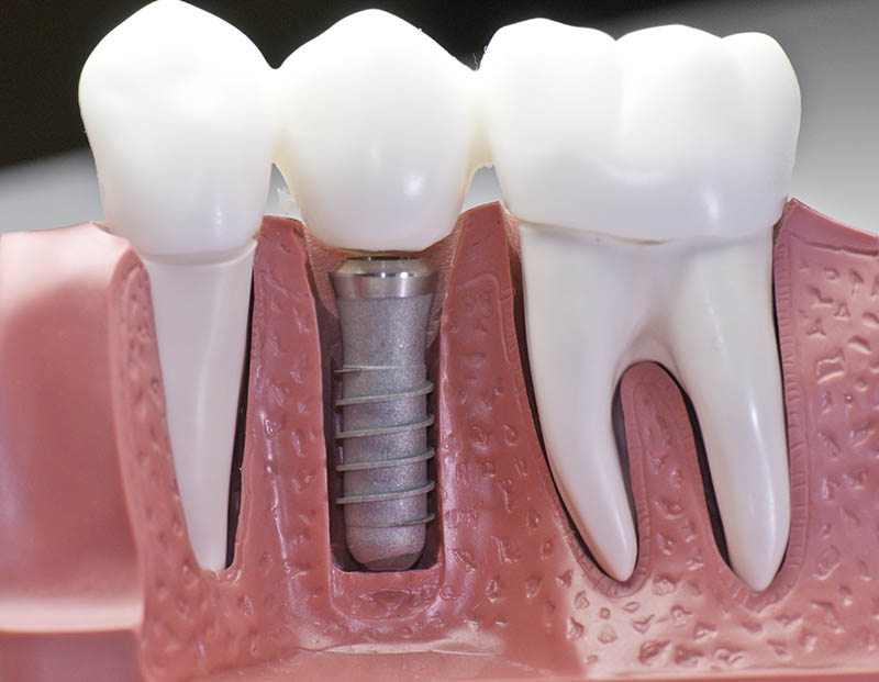 dental_implants_hurt