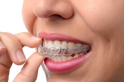 invisalign one stop implants