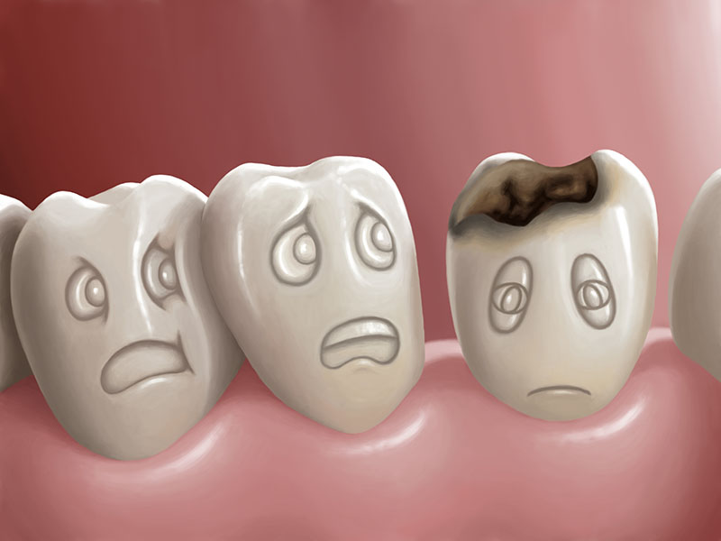 tooth_decay