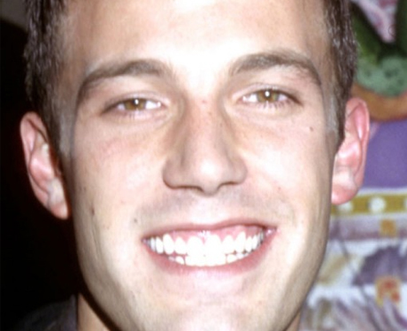 Ben Affleck Before Cosmetic Dentistry