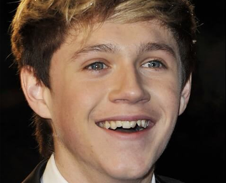 Niall Horan Before Cosmetic Dentistry