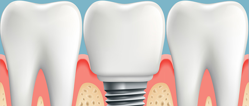 Dental Implant between two natural teeth