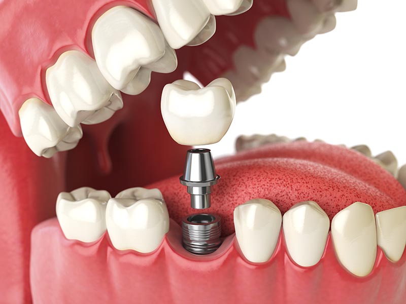 Diagram of Implant, Abutment, and Crown in Mouth