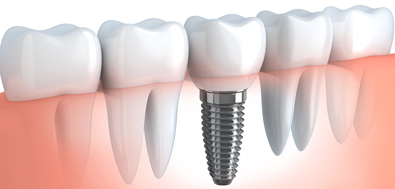 Dental Implants Placed in the Gum