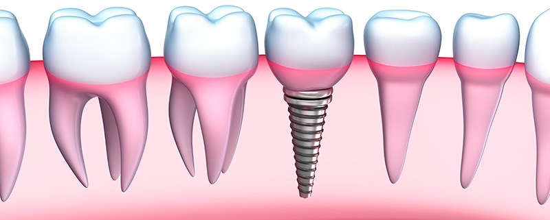 dental_implats_roots